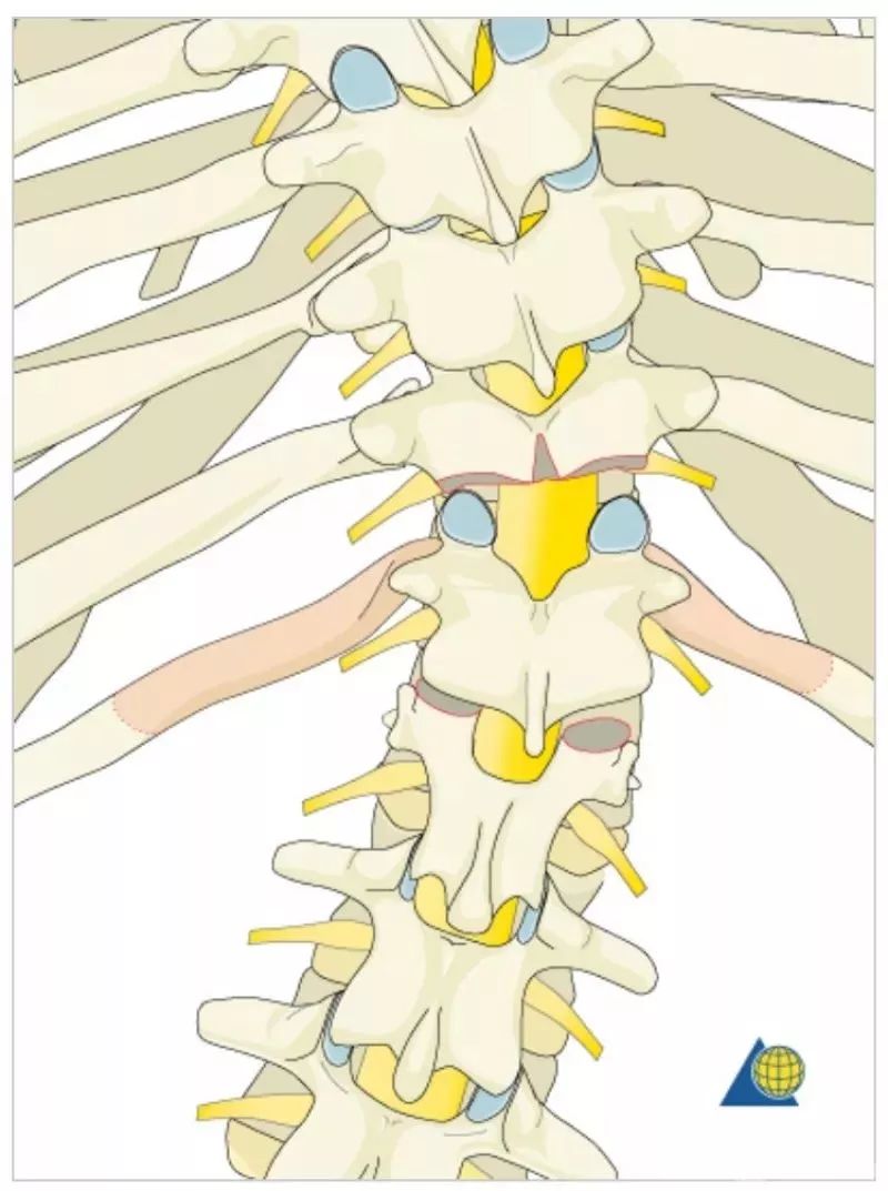 图文并茂！详解脊柱6级截骨术