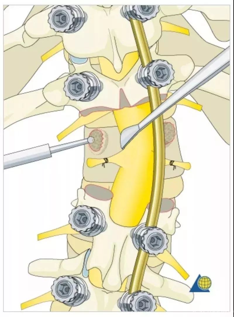 图文并茂！详解脊柱6级截骨术