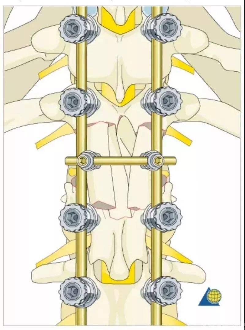 图文并茂！详解脊柱6级截骨术