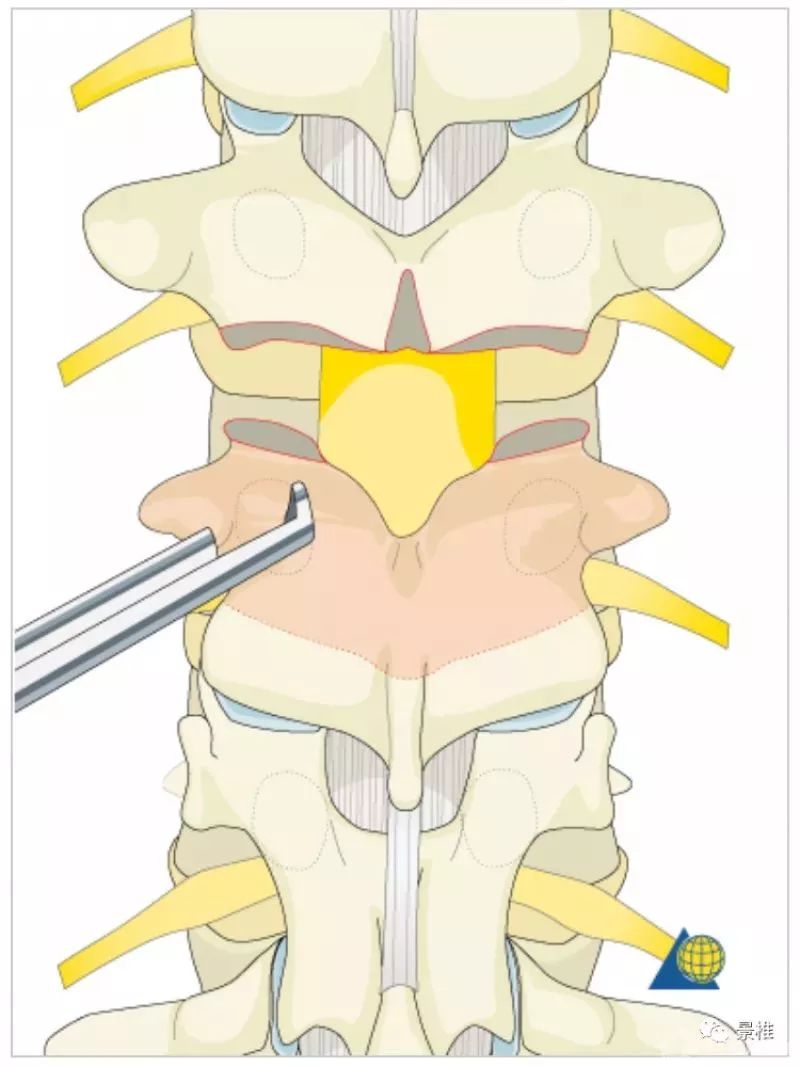 图文并茂！详解脊柱6级截骨术