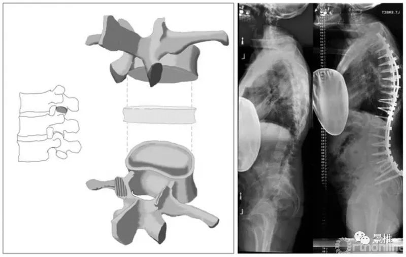 图文并茂！详解脊柱6级截骨术
