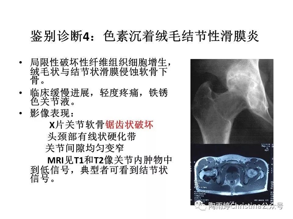 股骨头坏死的诊断与保髋方法的选择