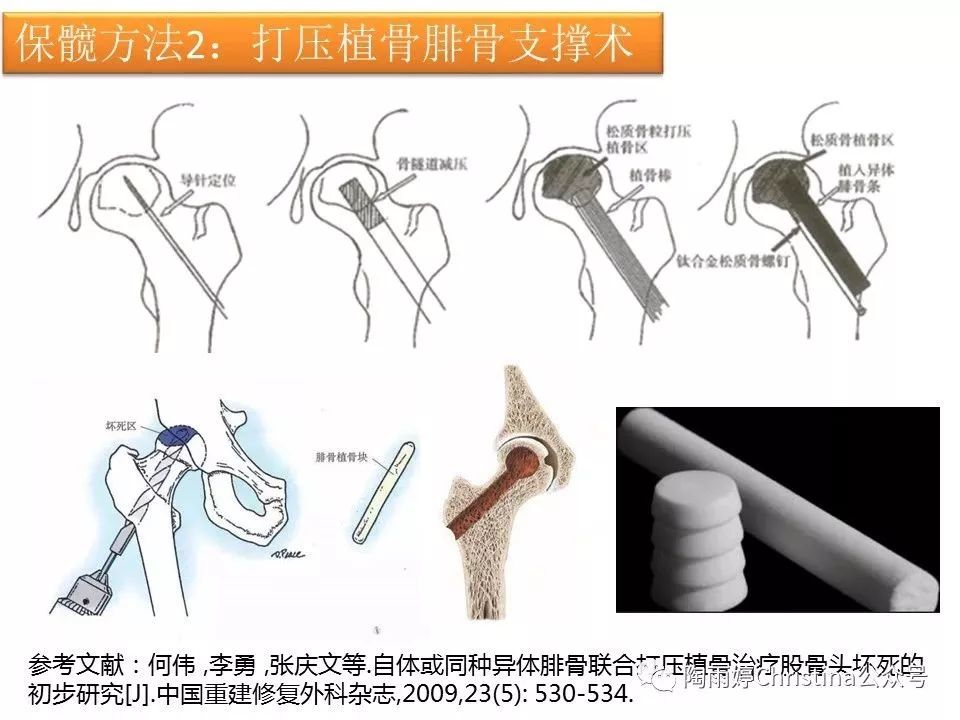 股骨头坏死的诊断与保髋方法的选择