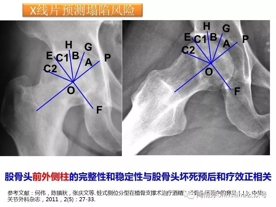 股骨头坏死的诊断与保髋方法的选择