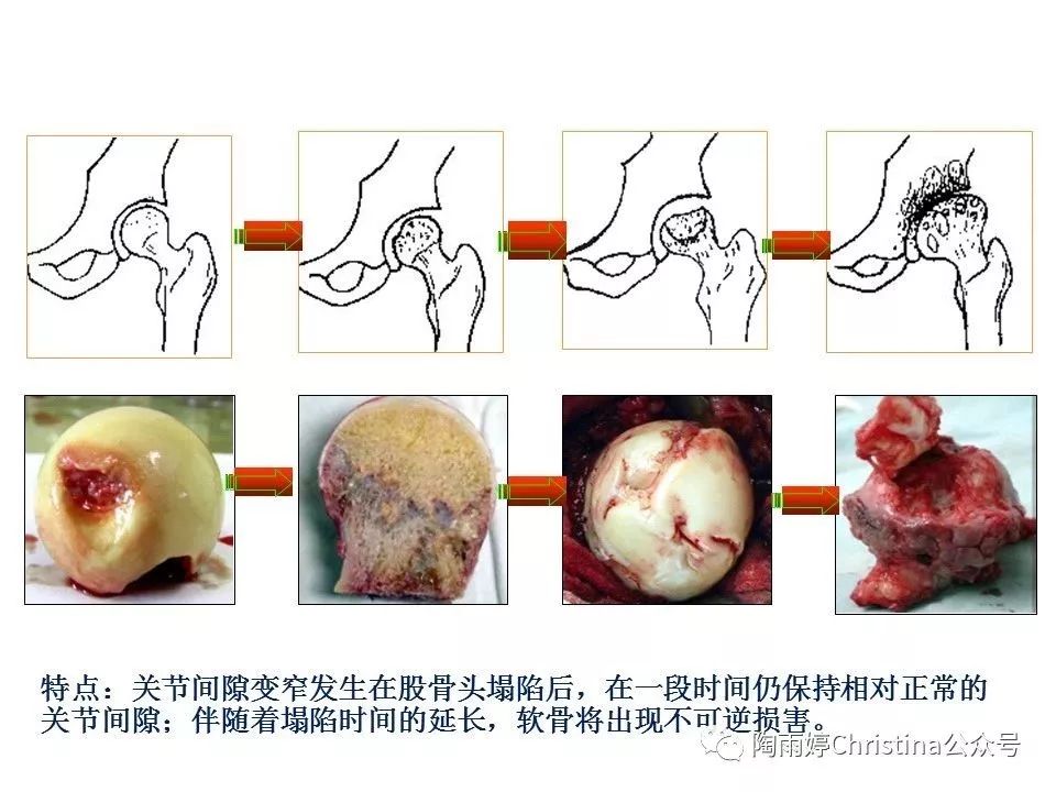 股骨头坏死的诊断与保髋方法的选择