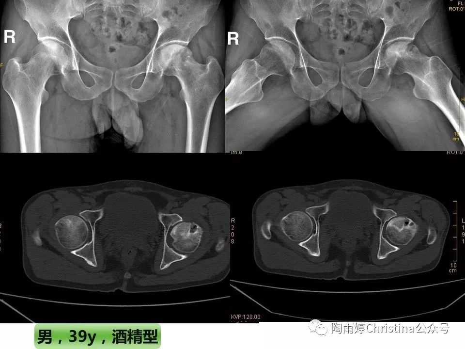 股骨头坏死的诊断与保髋方法的选择