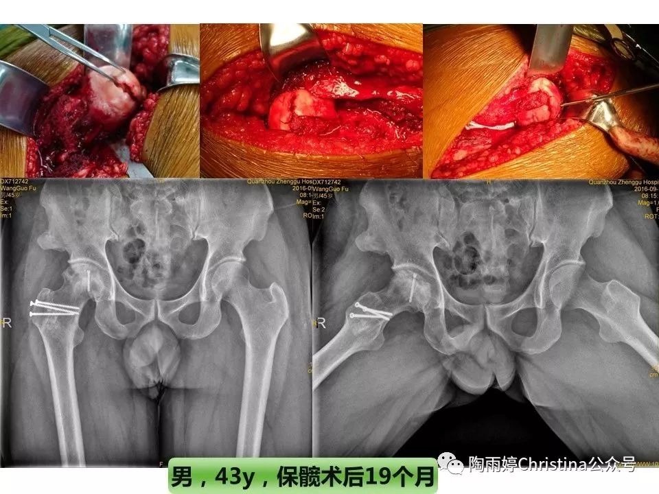 股骨头坏死的诊断与保髋方法的选择