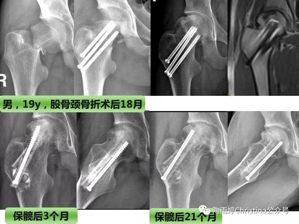 股骨头坏死的诊断与保髋方法的选择