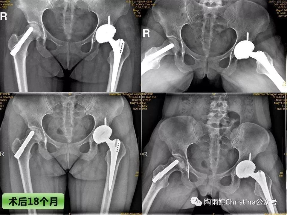 股骨头坏死的诊断与保髋方法的选择