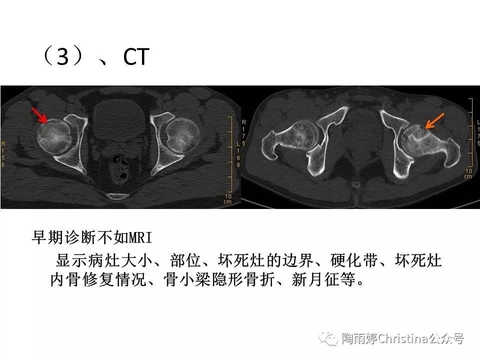 股骨头坏死的诊断与保髋方法的选择