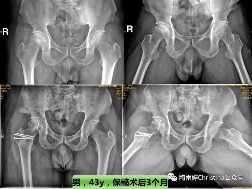 股骨头坏死的诊断与保髋方法的选择