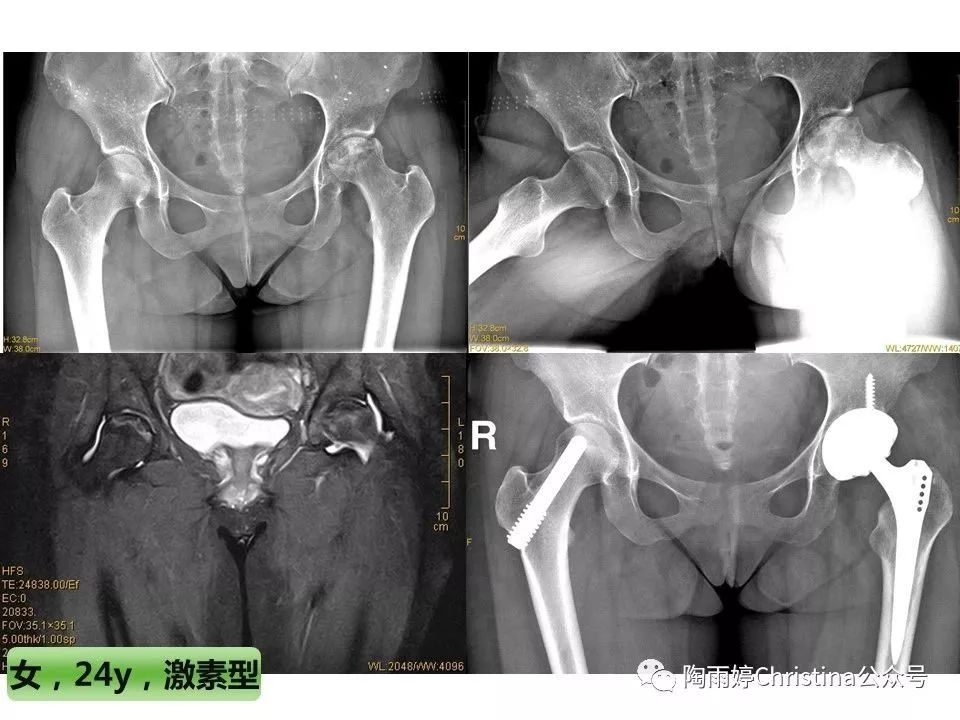 股骨头坏死的诊断与保髋方法的选择