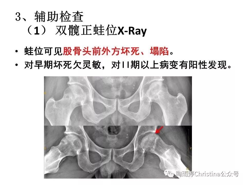 股骨头坏死的诊断与保髋方法的选择