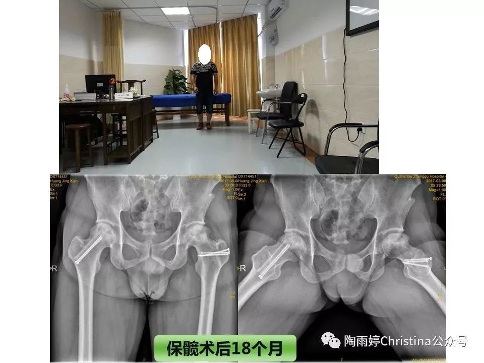 股骨头坏死的诊断与保髋方法的选择