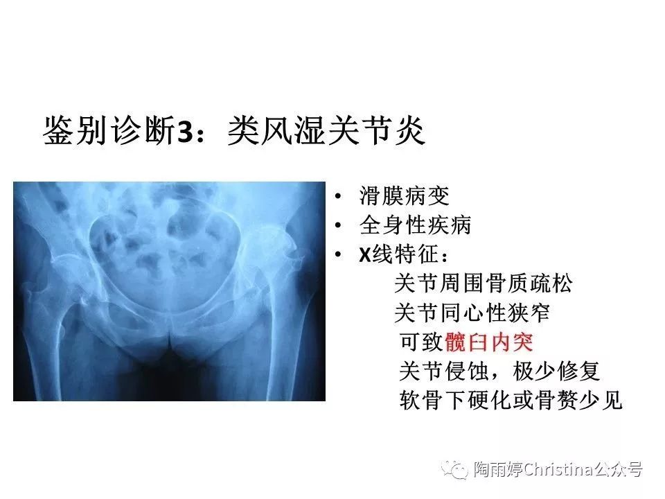 股骨头坏死的诊断与保髋方法的选择