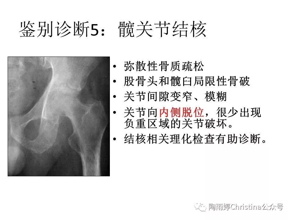 股骨头坏死的诊断与保髋方法的选择