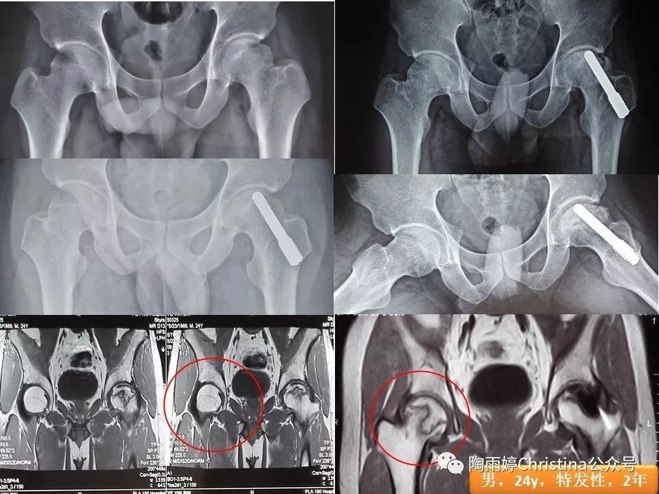 股骨头坏死的诊断与保髋方法的选择