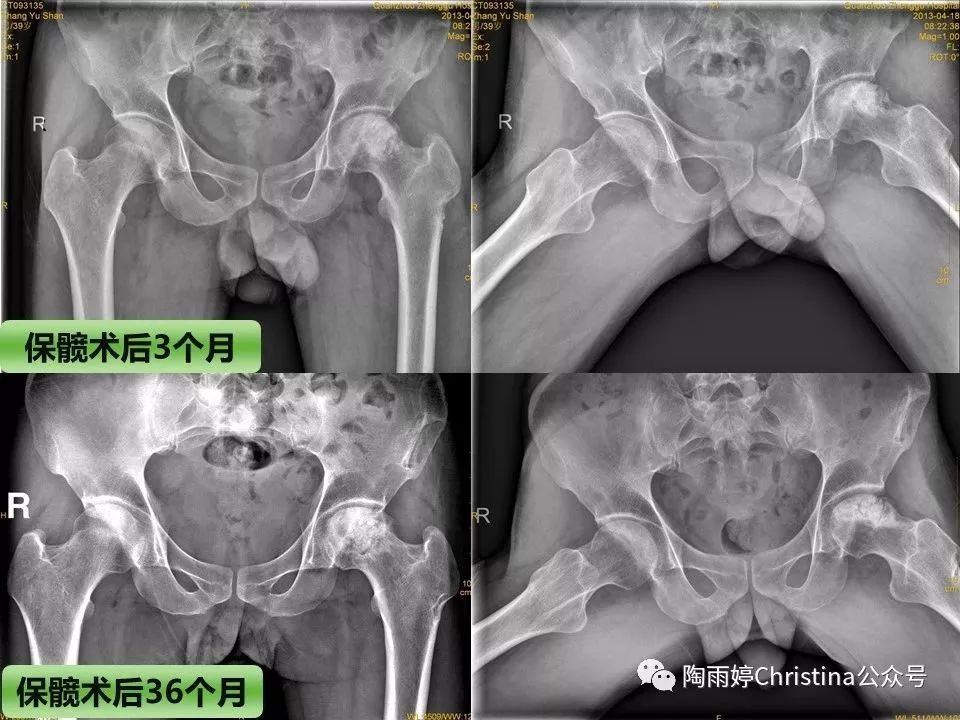 股骨头坏死的诊断与保髋方法的选择