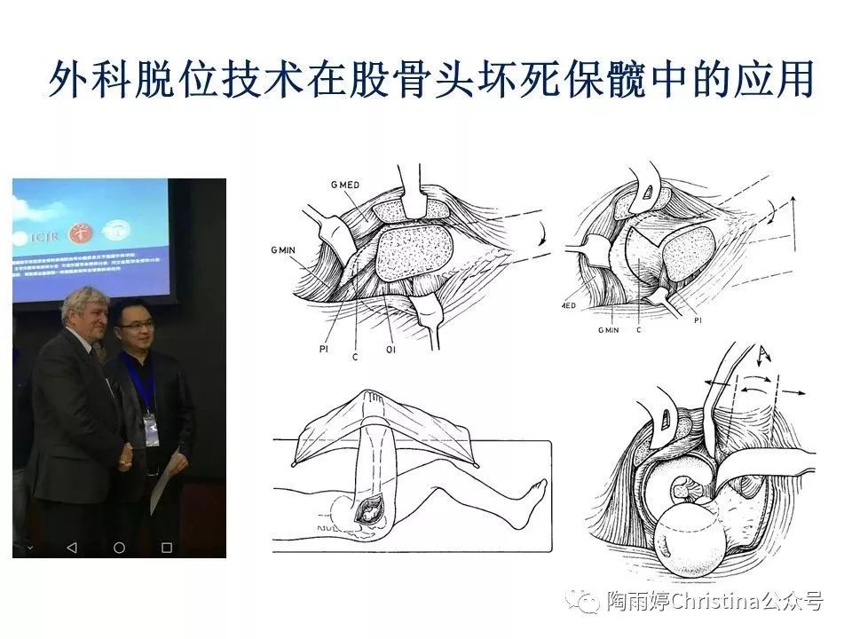 股骨头坏死的诊断与保髋方法的选择