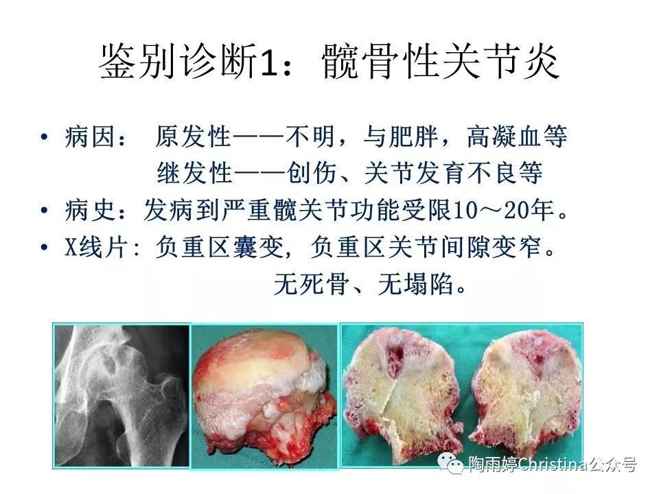 股骨头坏死的诊断与保髋方法的选择