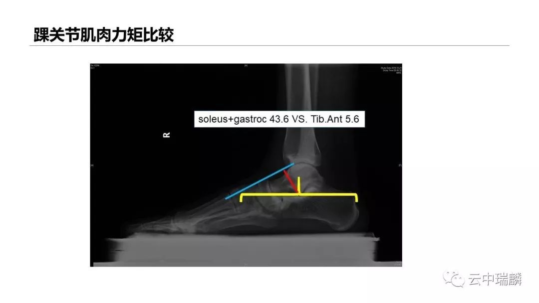 一文掌握：肌腱转位的原则及手术要点