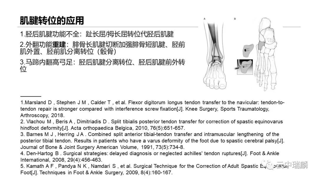 一文掌握：肌腱转位的原则及手术要点