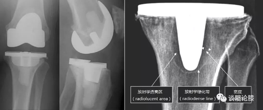 TKA中骨水泥知识，你真的都get了吗？