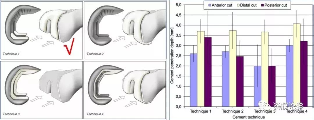 TKA中骨水泥知识，你真的都get了吗？