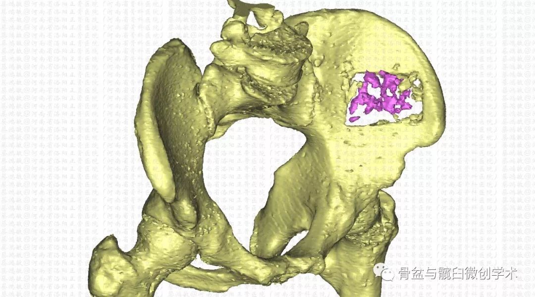 如何取自体髂骨，量大、安全且可再生？