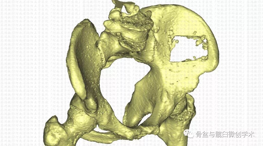 如何取自体髂骨，量大、安全且可再生？