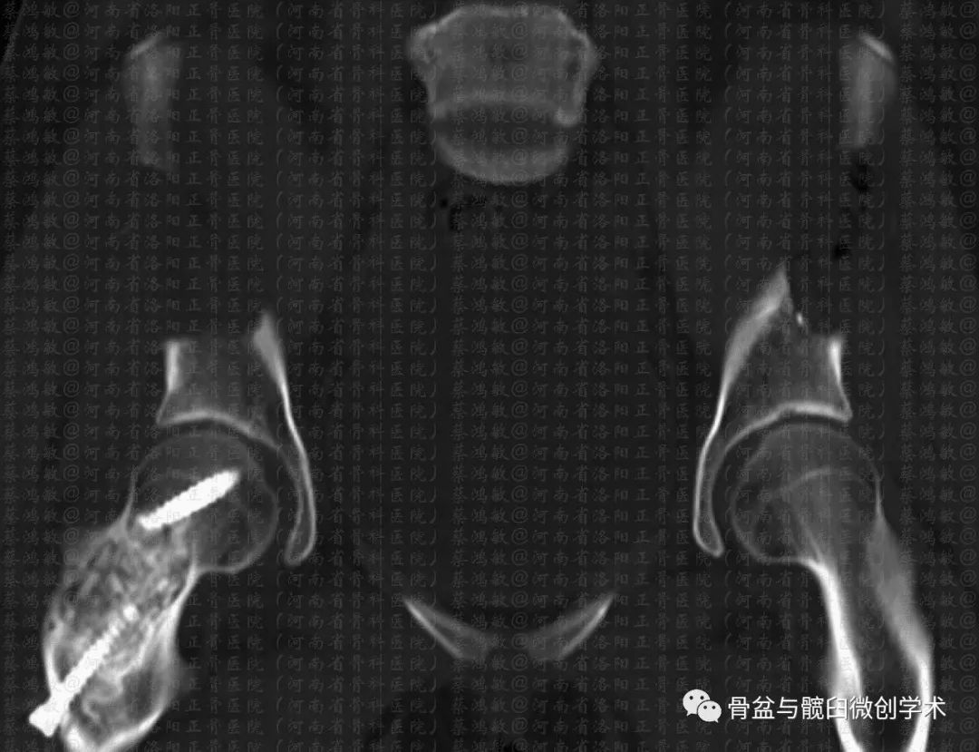 如何取自体髂骨，量大、安全且可再生？