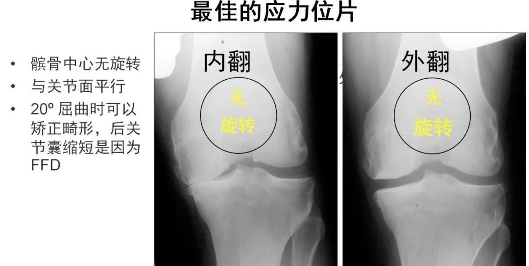 图解：单髁置换手术技巧，赶紧收藏起来！