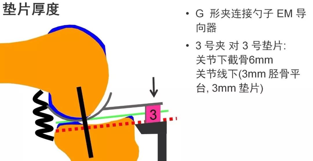 图解：单髁置换手术技巧，赶紧收藏起来！
