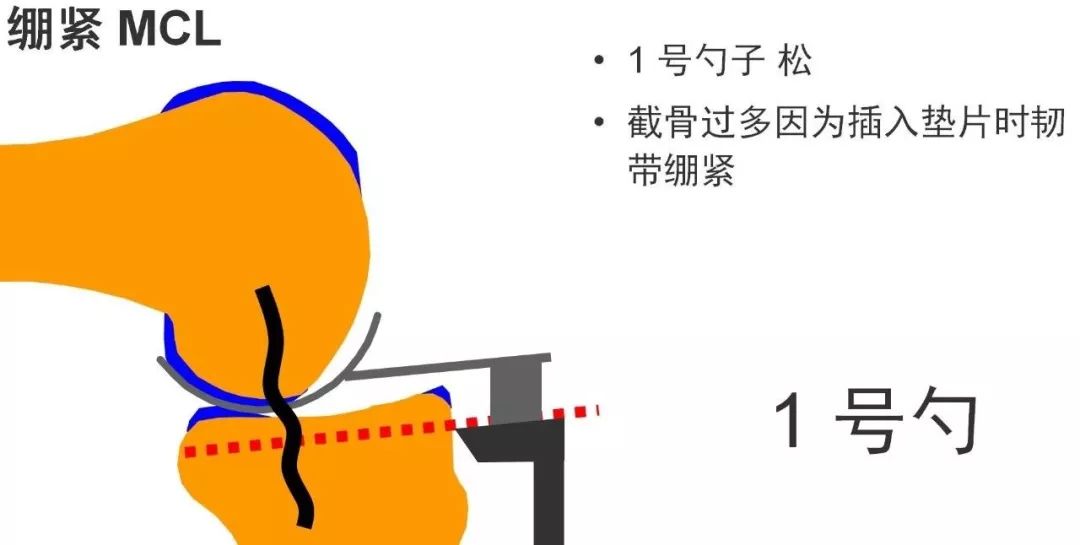 图解：单髁置换手术技巧，赶紧收藏起来！