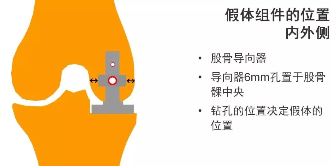 图解：单髁置换手术技巧，赶紧收藏起来！