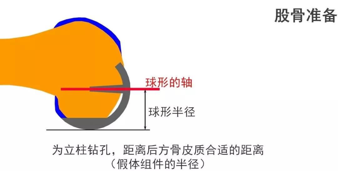 图解：单髁置换手术技巧，赶紧收藏起来！