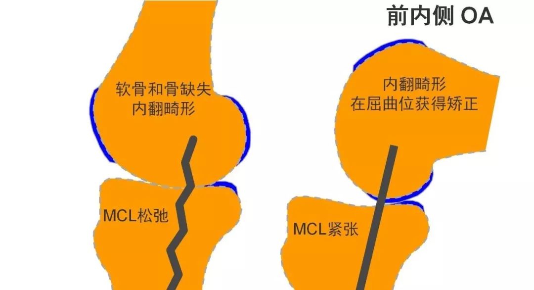 图解：单髁置换手术技巧，赶紧收藏起来！