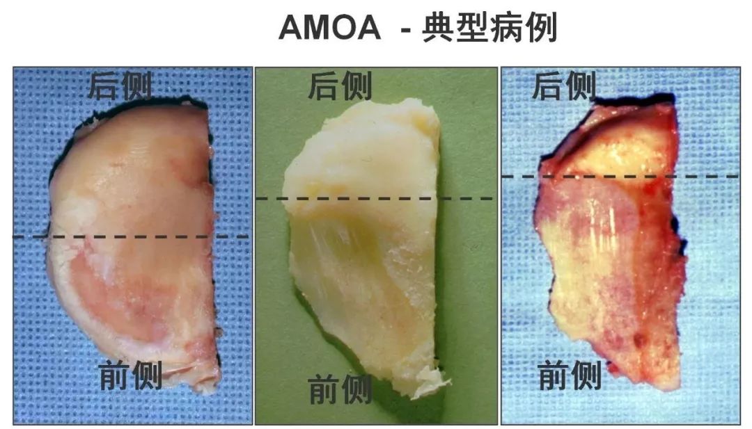 图解：单髁置换手术技巧，赶紧收藏起来！