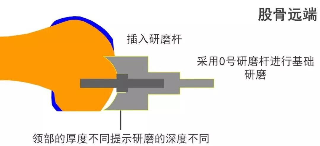 图解：单髁置换手术技巧，赶紧收藏起来！