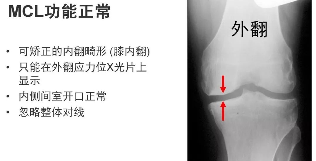 图解：单髁置换手术技巧，赶紧收藏起来！