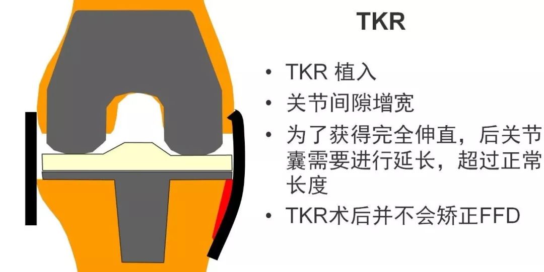 图解：单髁置换手术技巧，赶紧收藏起来！