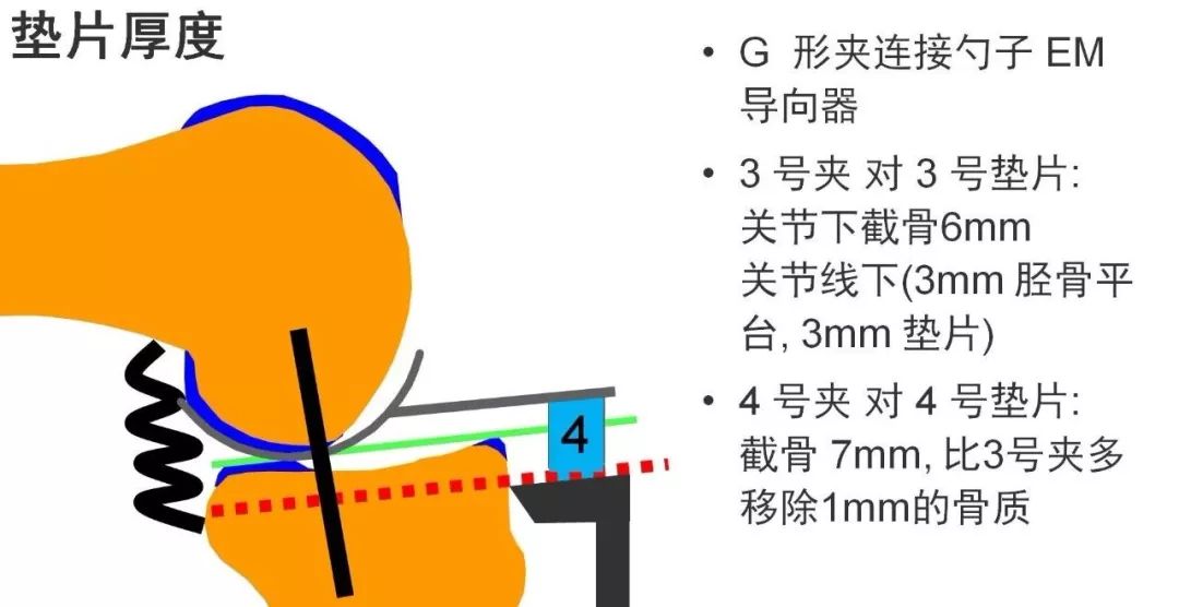 图解：单髁置换手术技巧，赶紧收藏起来！