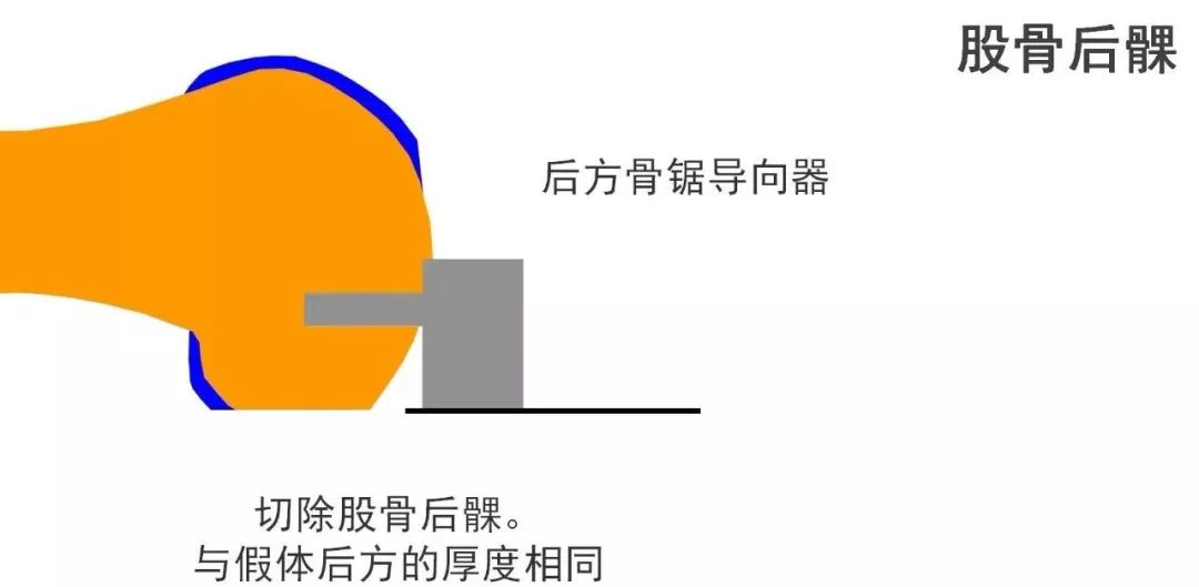 图解：单髁置换手术技巧，赶紧收藏起来！