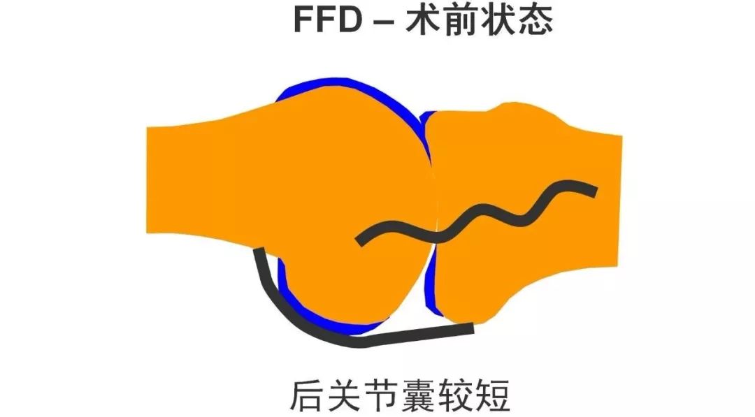 图解：单髁置换手术技巧，赶紧收藏起来！