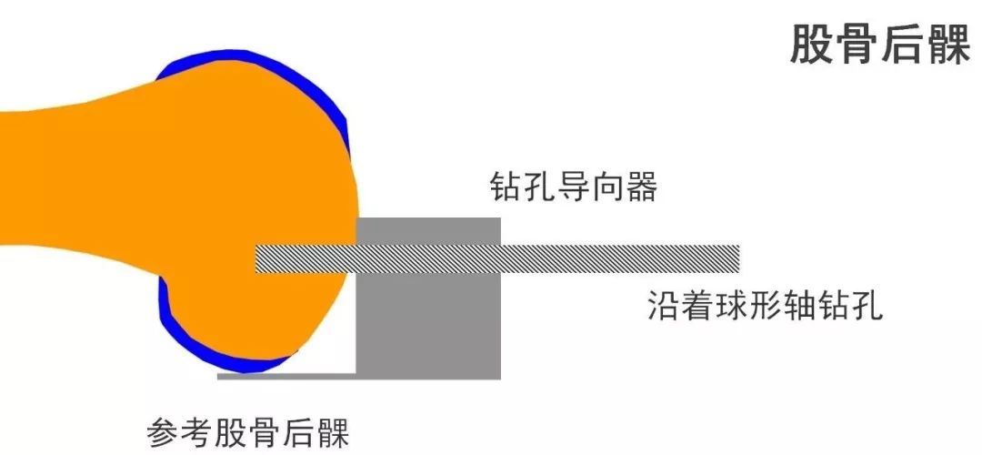 图解：单髁置换手术技巧，赶紧收藏起来！