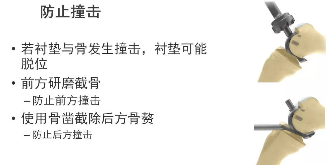 图解：单髁置换手术技巧，赶紧收藏起来！