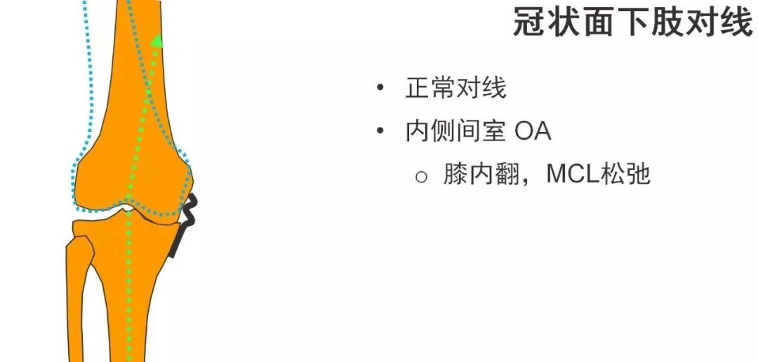 图解：单髁置换手术技巧，赶紧收藏起来！