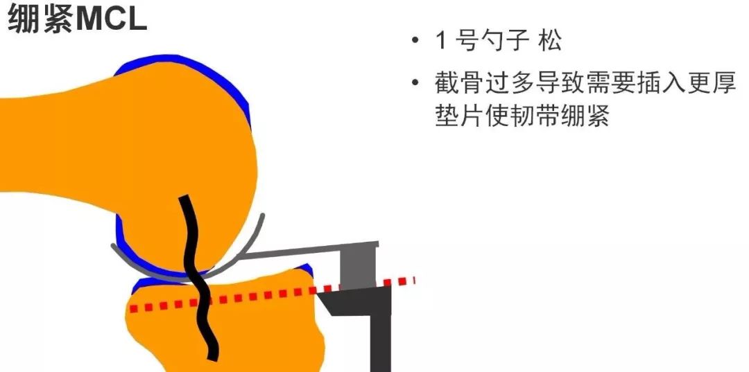 图解：单髁置换手术技巧，赶紧收藏起来！