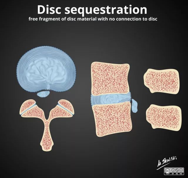 椎间盘膨出、突出、脱出如何鉴别？6