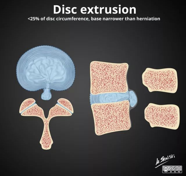 椎间盘膨出、突出、脱出如何鉴别？6